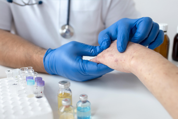 Monkeypox Disease
