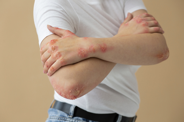 Shingles Disease